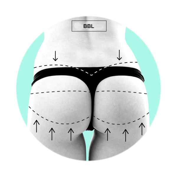 Lift brazilian surgery butt Brazilian Butt