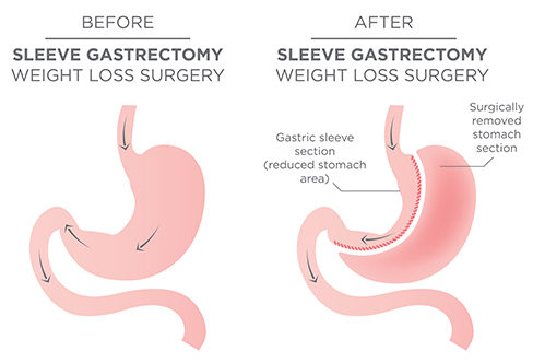 obesity surgery