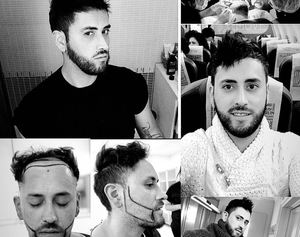 Hair transplant surgery in Turkey