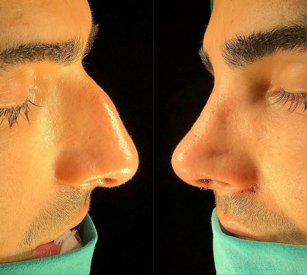 Rhinoplasty Surgery in turkey