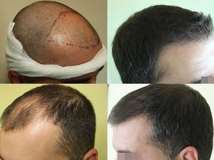 hair transplant visit www.estexcellent.com
