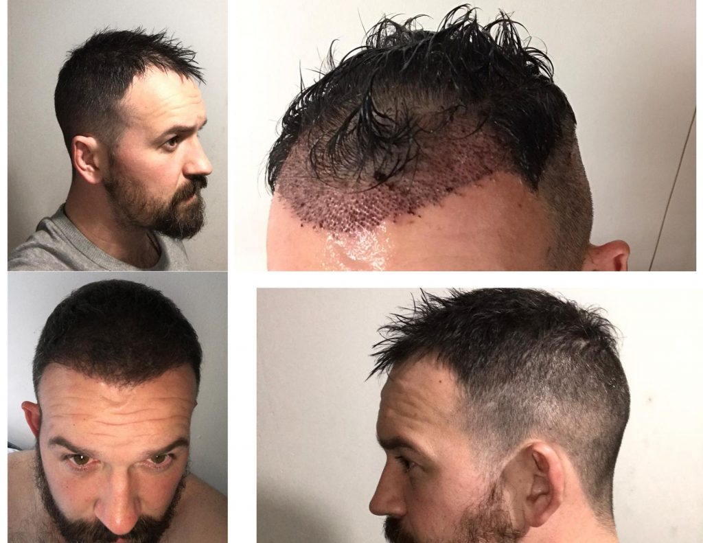 Hair transplant surgery in Turkey