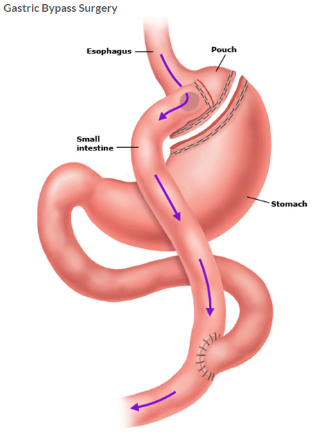 obesity surgery