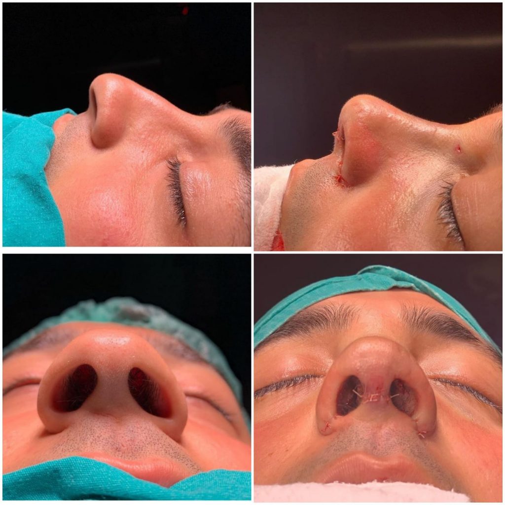 Rhinoplasty Surgery in Turkey