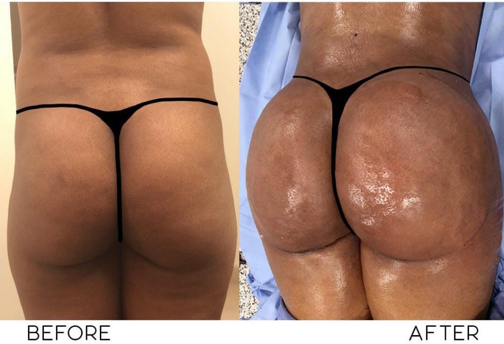 Brazilian butt lift surgery 