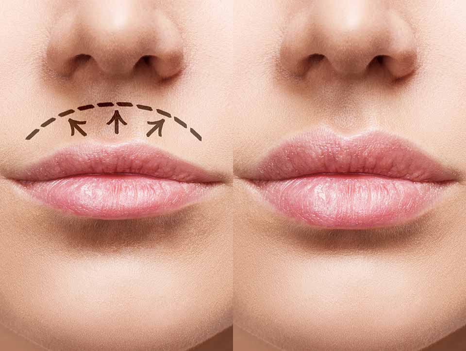 fanny liplift 1