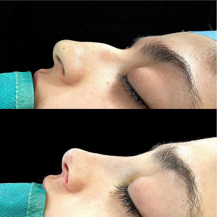 Rhinoplasty Surgery in turkey