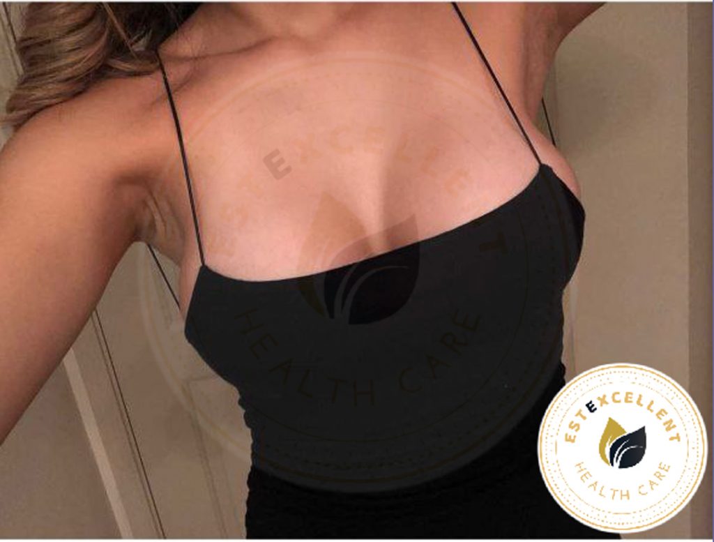 breast augmentation
