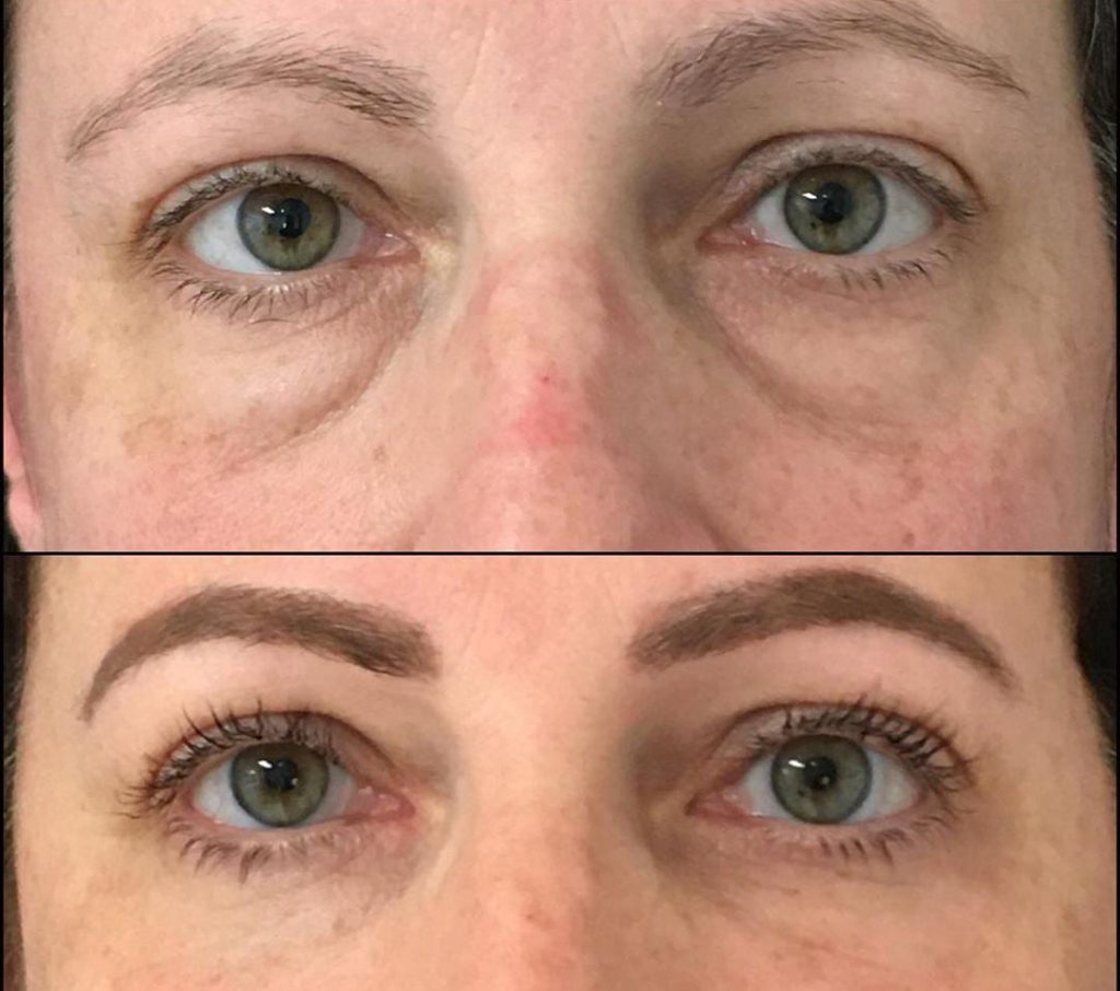 blepharoplasty